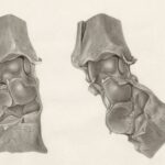life expectancy after compression fracture